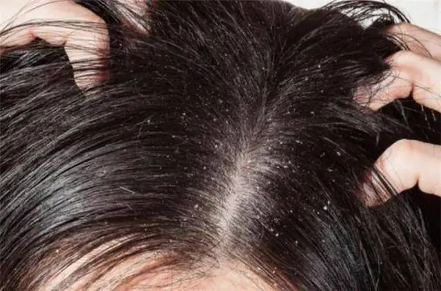  حلم قشرة الشعر - تفسير الاحلام