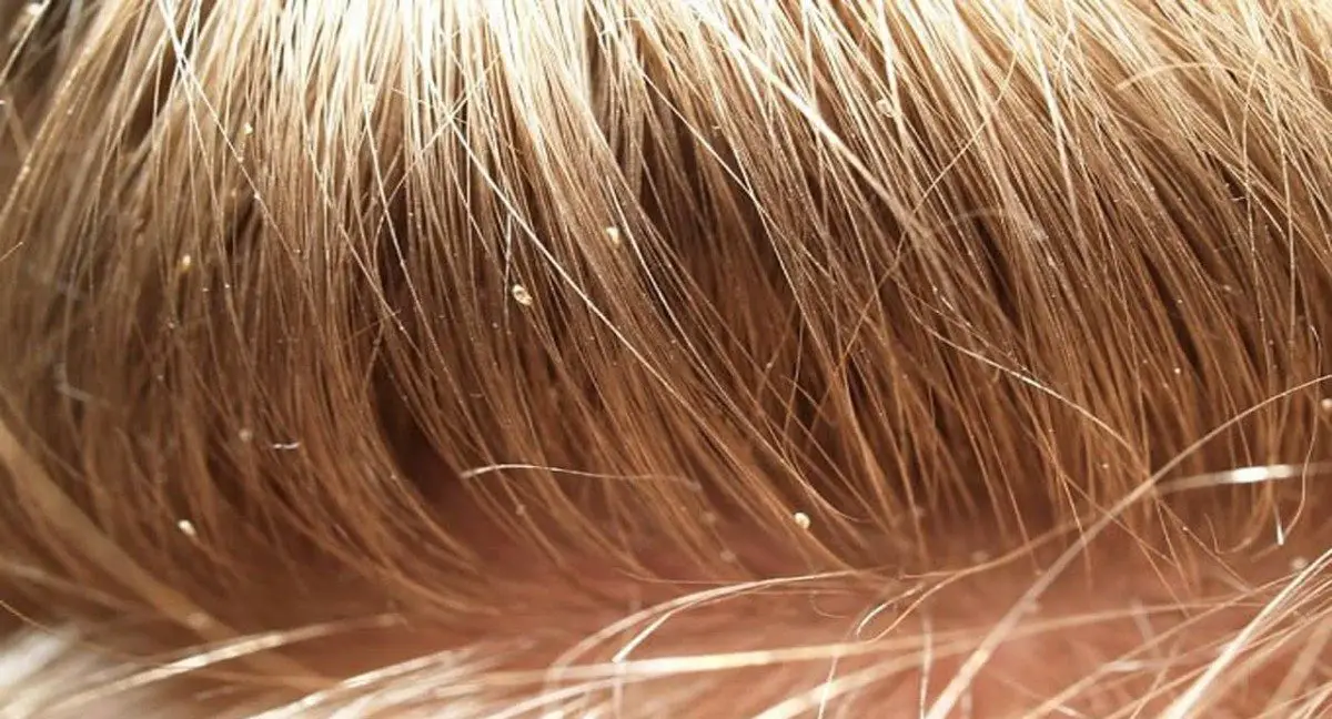 Svajonės apie utėlių matymą plaukuose aiškinimas
