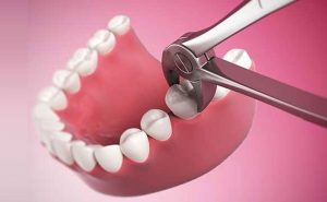 The fall of the tooth in a dream