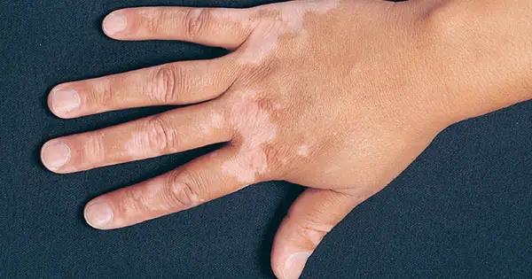 Nkọwa nke nrọ banyere vitiligo na aka maka ụmụ nwanyị na-alụbeghị di