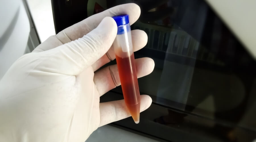 من جربت تحليل الدم بجهاز البول وكيفية إجراءه