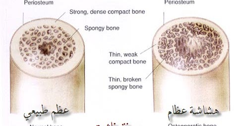 هل يمكن علاج هشاشة العظام بالاعشاب جابر القحطاني؟