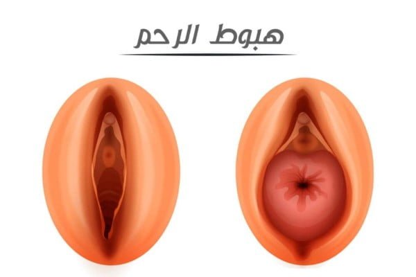 علاج هبوط الرحم بالمساج