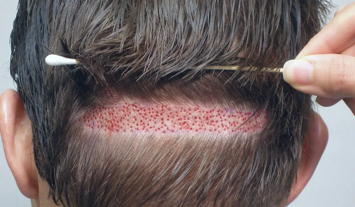 أهم عيادات زراعة الشعر في جدة
