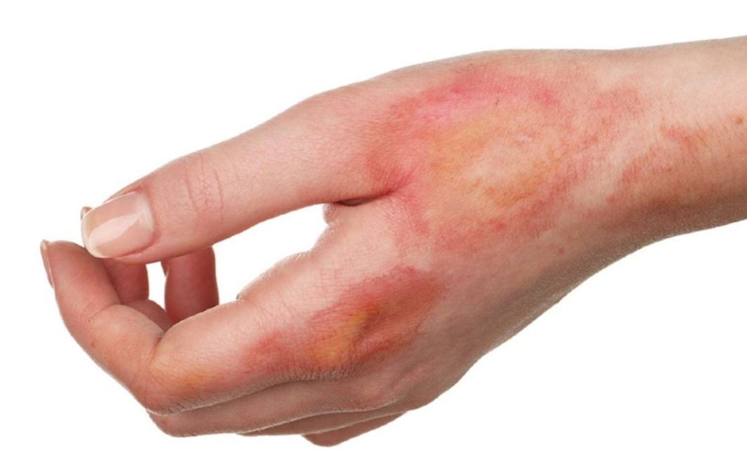 تفسير حلم اثار حروق في اليد