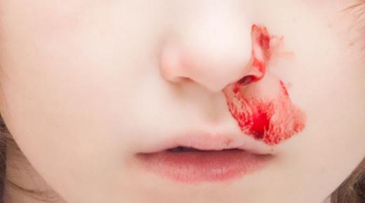 Сазнајте више о тумачењу крварења из носа у сну од Ибн Сирина