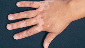 Cad é an léirmhíniú ar fhís vitiligo i aisling?