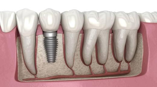 Детали за цената на непосредните забни импланти во Медицинскиот центар за стоматолошка нега!