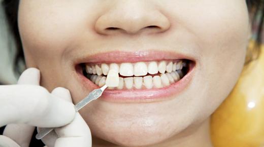 ما هو تفسير تركيب اسنان في المنام لابن سيرين؟